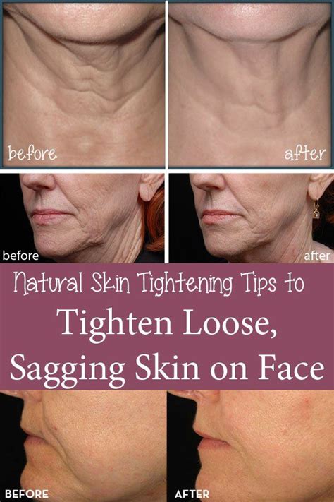 17 Best Images About Skin And Face On Pinterest Sagging