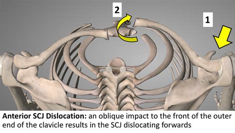 Anterior Dislocations Cambridge Shoulder