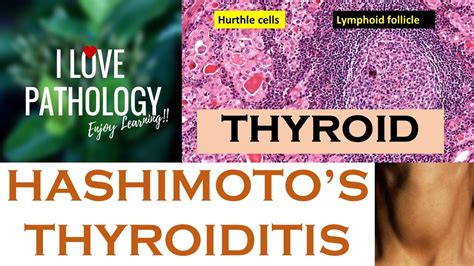 Hashimotos Thyroiditis Etiopathogenesis Morphology And Complications