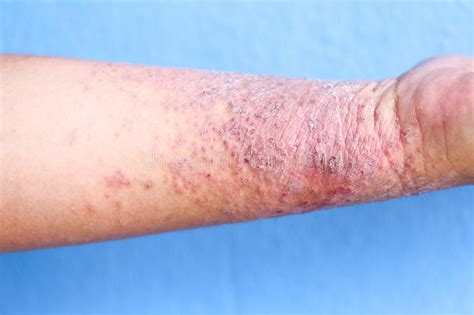 Atopic Dermatitis Ad Also Known As Atopic Eczema Is A Type Of