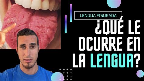 ¿por Qué Tiene La Lengua Agrietada Causas De La Lengua Fisurada O