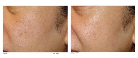 Old Age Brown Spots Archives Natural Skin Care Solutions Age Spots