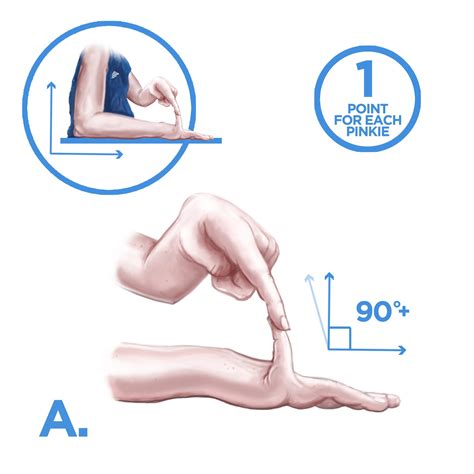 Assessing Joint Hypermobility The Ehlers Danlos Society