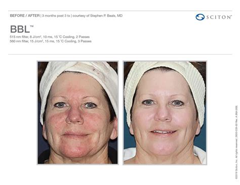 Sciton Bbl Orlando Laser Skin Rejuvenation Med Spa Skin Care Procedures