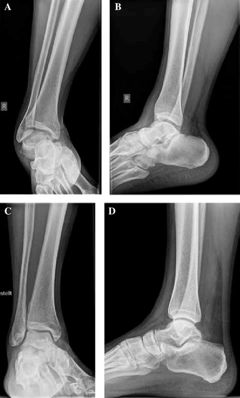 Radiographs Of A 39 Year Old Male Patient With Medial Subtalar