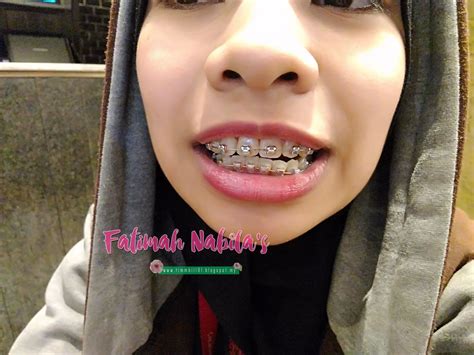 Pengalaman 150 Hari Dengan Braces Fatimahnabila