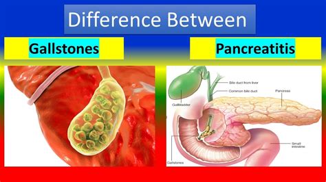 Difference Between Gallstones And Pancreatitis Youtube