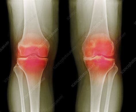 Arthritic Knees X Ray Stock Image F0030246 Science Photo Library