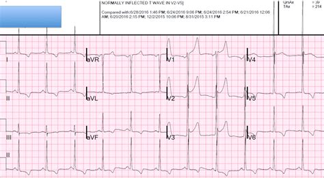 Dr Smith S Ecg Blog Is This Stemi Lvh Early Repolarization