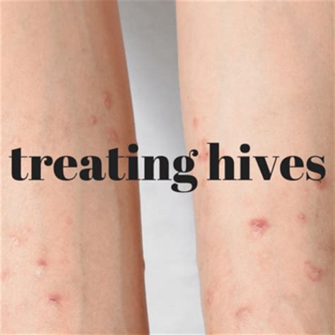 Check spelling or type a new query. Dr. Oz What Do Hives Look Like? Why Your Body Has an ...