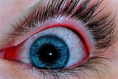 Excessive Eye Redness Red Eyes Causes Treatment Prevention
