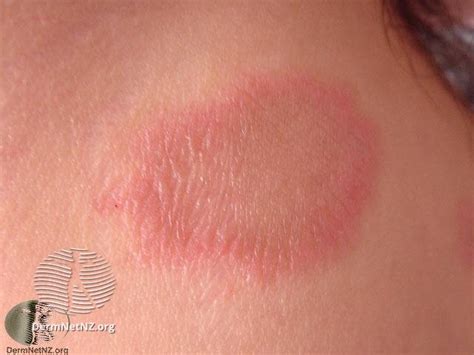 Red Scaly Rash Heres Why You Need A Dermatologist To