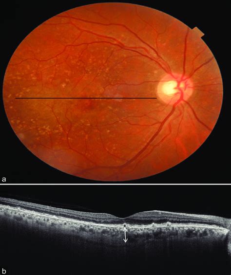 Shows The Fundus Photograph A Of A 66 Year Old Patient With Presence