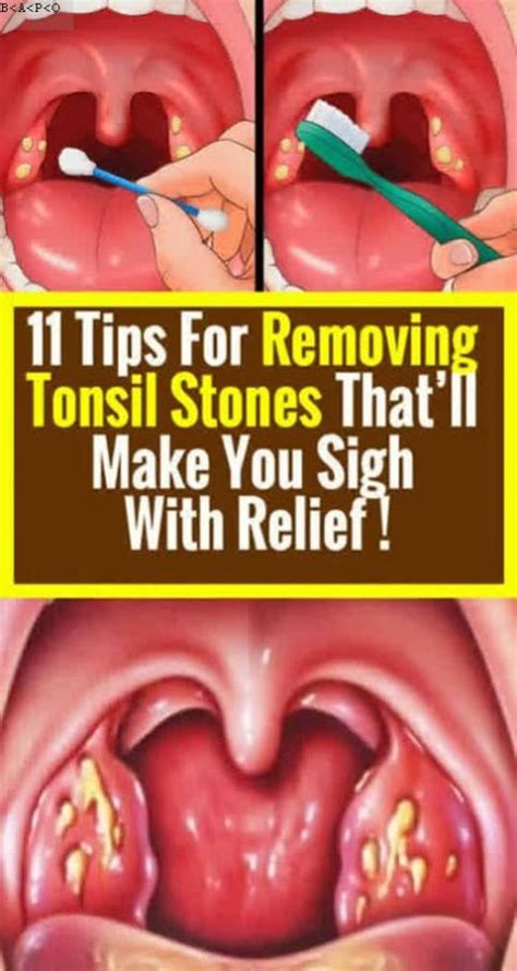 How To Remove Tonsil Stones Video Howotremvo