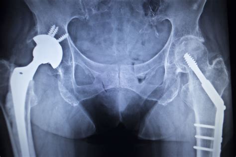 Stryker Accolade Hip Stem Implant Injuries Prompt Wisconsin Couple To