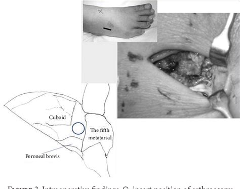Figure 1 From A Case Report Of Isolated Cuboid Nutcracker Fracture