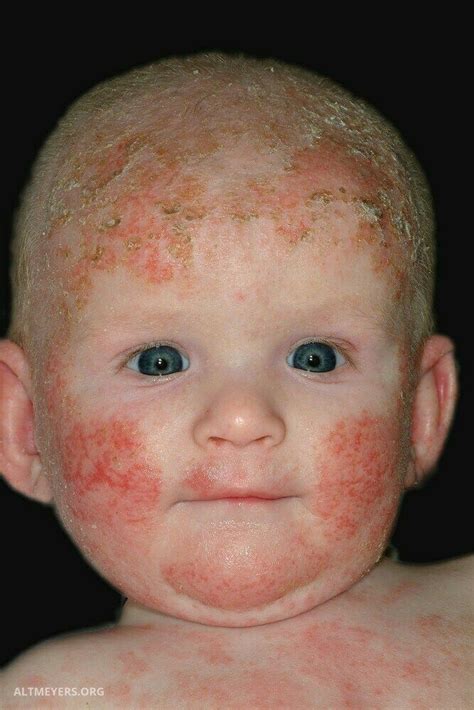 Atopic Dermatitis In Children Healthy Food Near Me