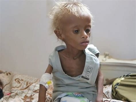 Read UN: 400,000 Starving Yemen Children Face Risk Of Death Online