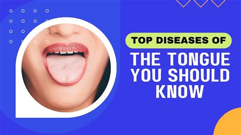 Top Diseases Of The Tongue You Should Know Youtube