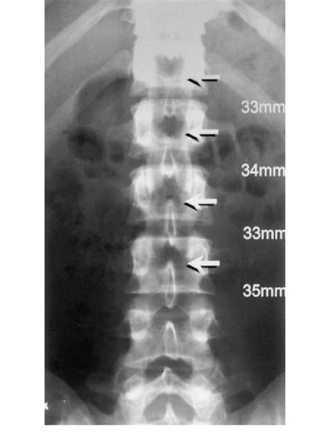 This area includes the lumbar region and the sacrum, the area that connects the spine to the pelvis. A normal AP radiograph of lumbar spine showing the ...
