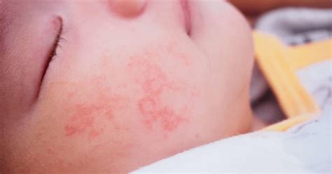 How To Identify Treat And Prevent Heat Rash In Children