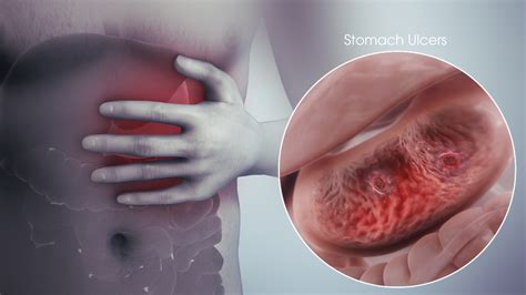 Various Reasons For Stomach Ulcer Scientific Animations