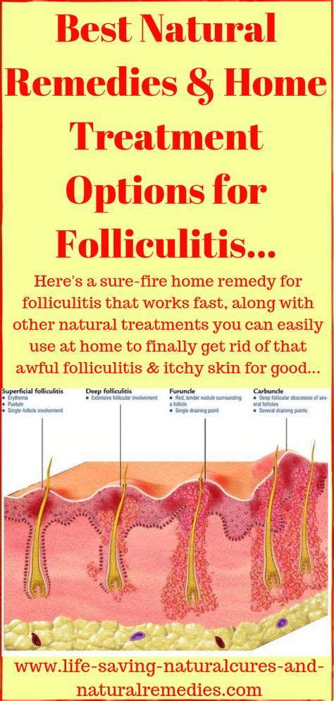 5 Home Remedies For Folliculitis That Work A Treat Natural