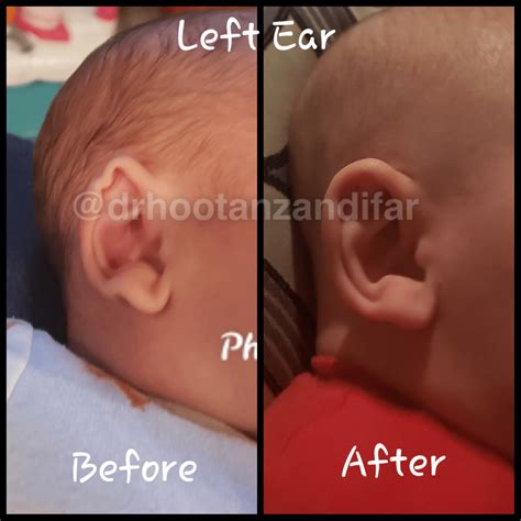 Ear Molding For Infants Infant Ear Molding Cost Beverly Hills Ca