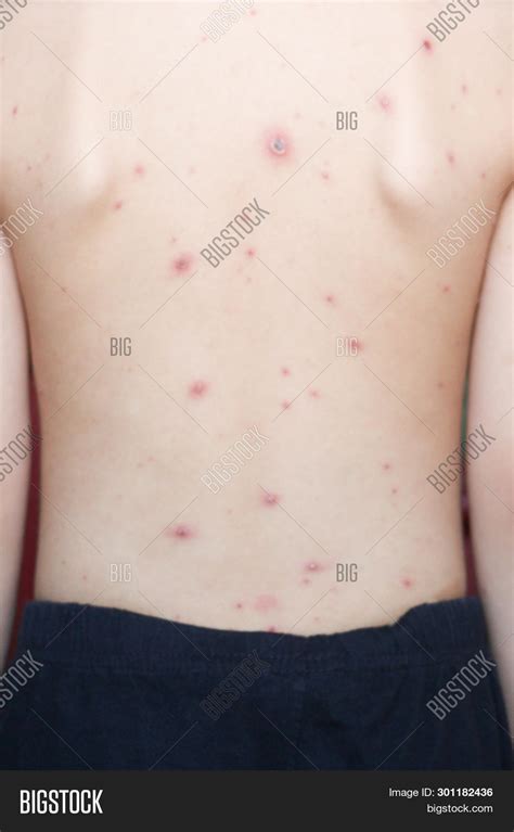 Chicken Pox Rash On Young Boy Bodychickenpox Is An Infection Caused By