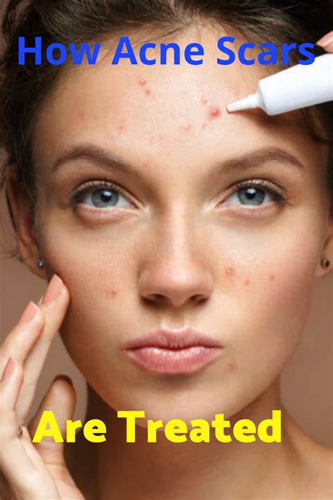 How The Acne Scars Are Treated