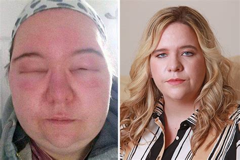 Brit Mum Looked Like Monster After Horrifying Allergic Reaction To