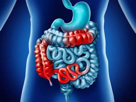 Ibd Treatments And Causes Inflammatory Bowel Disease Overview