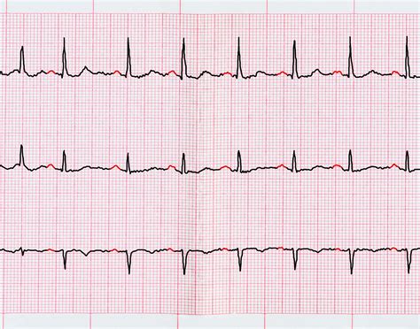 Atrial Fibrillation Mortality May Increase With Digoxin The