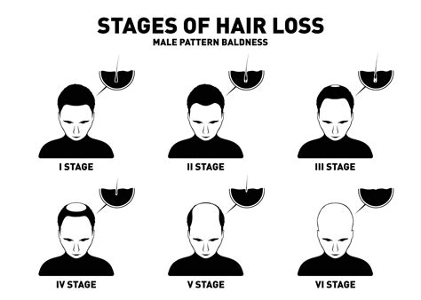 What Should Know About Male Pattern Baldness Tonys Hair Replacement