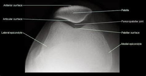 Diagnostic Medical Imaging Patella Skyline View X Ray Anatomy