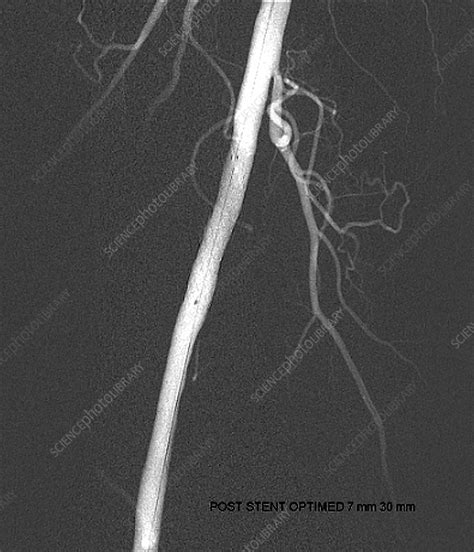 Leg Artery Angioplasty Angiogram Stock Image C0489306 Science