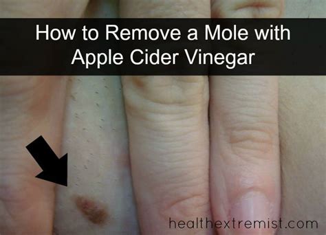 My Apple Cider Vinegar Mole Removal Experiment Worked
