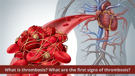 What Is Thrombosis Causes Symptoms Treatment And Complications