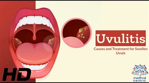 Uvulitis Explained Whats Causing Your Swollen Uvula Youtube