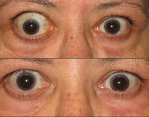 Thyroid Eye Disease Photos TEPEZZA Teprotumumab Trbw