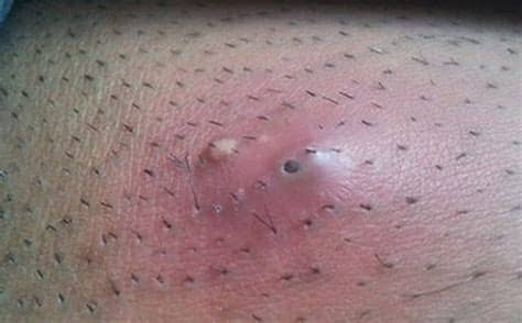 Even though red bumps and pimples may all look the same. Ingrown Hair Lump, Cyst, Bump, Under Skin, on Neck, Armpit ...
