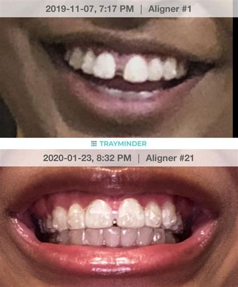 Gums In Between Gap Teeth Are Now Swelling Week 24 And Causing