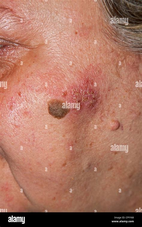 Inflamed Skin Rash Due To A Chromium Nickel Allergy And Seborrheic