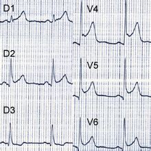Acute myocarditis is the diagnosis in 75% of patients with acute chest pain and elevated serum troponin levels at presentation and who have unobstructed coronary arteries at invasive catheterization ().at unselected routine necropsies, myocarditis is found in up to 0.6% of patients ().estimations are that myocarditis is the underlying cause for dilated cardiomyopathy previously. Myocardite - IRM Cardiaque par Neteditions