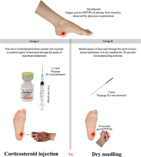 Comparison Of Dry Needling And Steroid Injection In The Treatment Of Plantar Fasciitis A Single