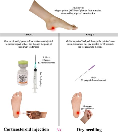 Comparison Of Dry Needling And Steroid Injection In The Treatment Of