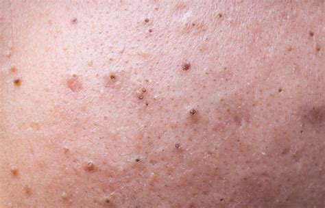 How To Remove Deep Blackheads Safely And Effectively