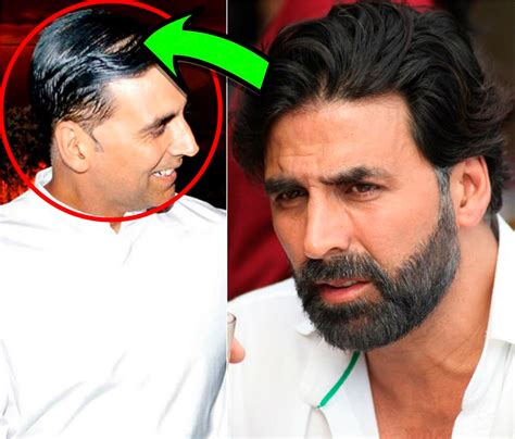 From Bollywood To Hollywood Celebrities Who Went For Hair Transplant