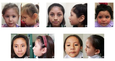 Fileindividuals Of Latin American Descent With Turner Syndrome