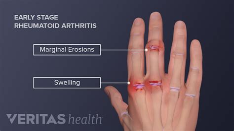 Hand Pain And Rheumatoid Arthritis